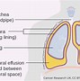 Image result for Pleural Diseases