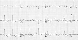 Image result for Right Ventricular Hypertrophy Echo