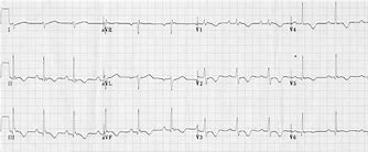 Image result for Right Ventricular Hypertrophy