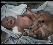 Image result for Teratoma Baby Boy