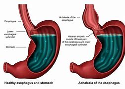 Image result for Esophageal Sphincter Spasm