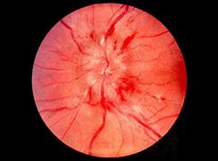 Image result for Papilledema