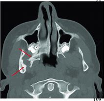 Image result for Pterygoid Plate