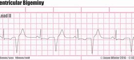 Image result for Bigeminy PVC ECG