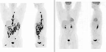 Image result for Pet Scan Lymphoma Example