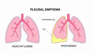 Image result for Right-Sided Empyema