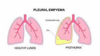 Image result for Pathophysiology of Empyema