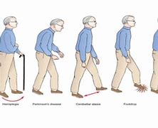 Image result for Lumbering Gait