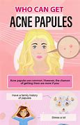 Image result for Treating Papules