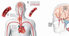 Image result for Acute Stroke