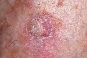 Image result for Squamous and Basal Cell Cancer