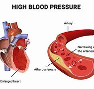 Image result for Google High Blood Pressure Image