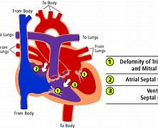 Image result for AV Canal Defect Down Syndrome