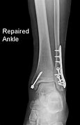 Image result for ORIF Ankle Fracture