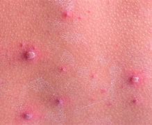 Image result for Pustule Rashes