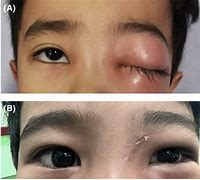 Image result for Subperiosteal Abscess Orbital Cellulitis