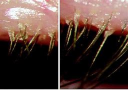 Image result for Eyelash Worms