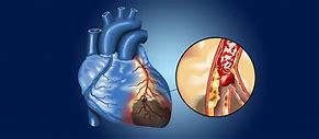 Image result for SCV Thrombosis