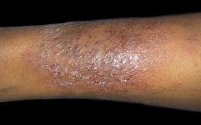 Image result for Eczema On Darker Skin