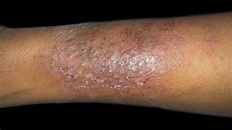 Image result for Eczema On Black Skin with Grey Colour