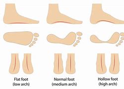 Image result for Arch Collaps Feet