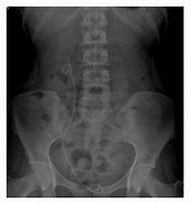 Image result for Right Ureter X-ray