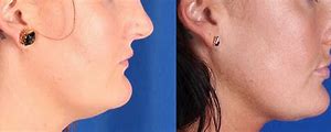 Image result for CoolSculpting Chin Before and After