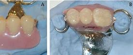 Image result for Partial Denture Clasps