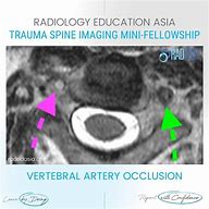 Image result for Vertebral Dissection On Angiogram