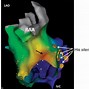 Image result for Atrioventricular Reciprocating Tachycardia