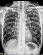 Image result for Chest X-ray of TB