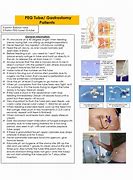 Image result for PEG Tube Replacement