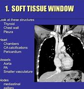 Image result for Lung Window CT