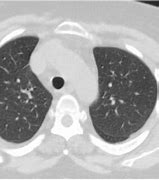 Image result for CT Chest Lung Window