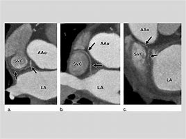 Image result for Retrocaval Artery