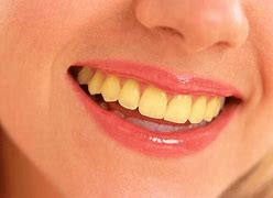 Image result for Teeth with Yellow Stuff