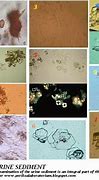 Image result for Sedimen Urin