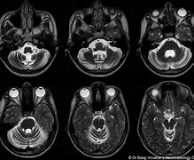 Image result for Ataxia MRI