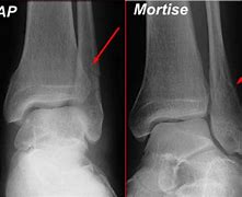 Image result for Left Ankle Fracture of Posterior Malleolus