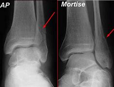 Image result for Verticam Medial Malleolus Fracture