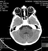 Image result for Enlarged Optic Nerve