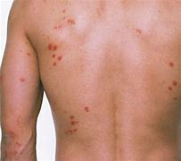 Image result for Baby Bed Bug Bites