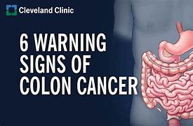 Image result for Cancer De Colon Tac