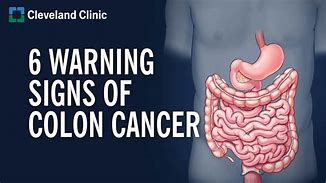 Image result for Pics of Colon Cancer