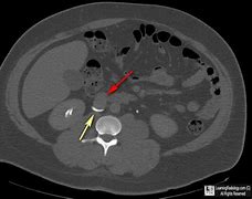 Image result for Retrocaval Surter Radiology