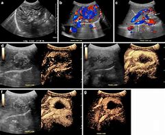 Image result for Hemangioma Ultrasound