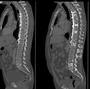 Image result for Sclerosis Bone Metastases X-ray