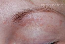 Image result for Flat Warts On Eyelids