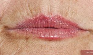 Image result for Upper Lip Wrinkles