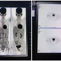 Image result for PET/CT For